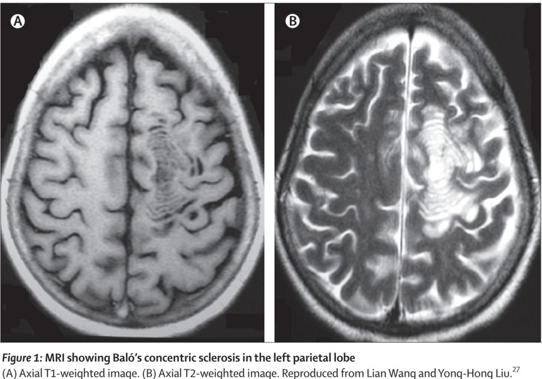 Whipple病、纹状体手、神经结节病、脱髓鞘假瘤丨3分钟读片·第16期
