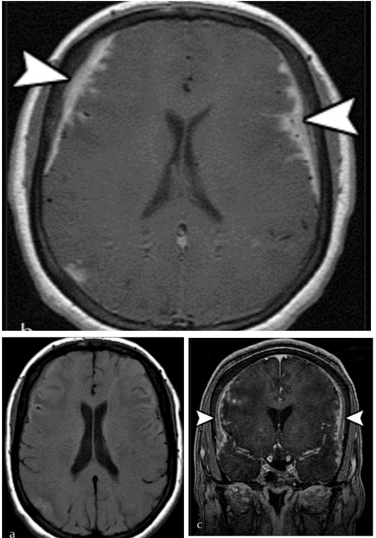 Whipple病、纹状体手、神经结节病、脱髓鞘假瘤丨3分钟读片·第16期