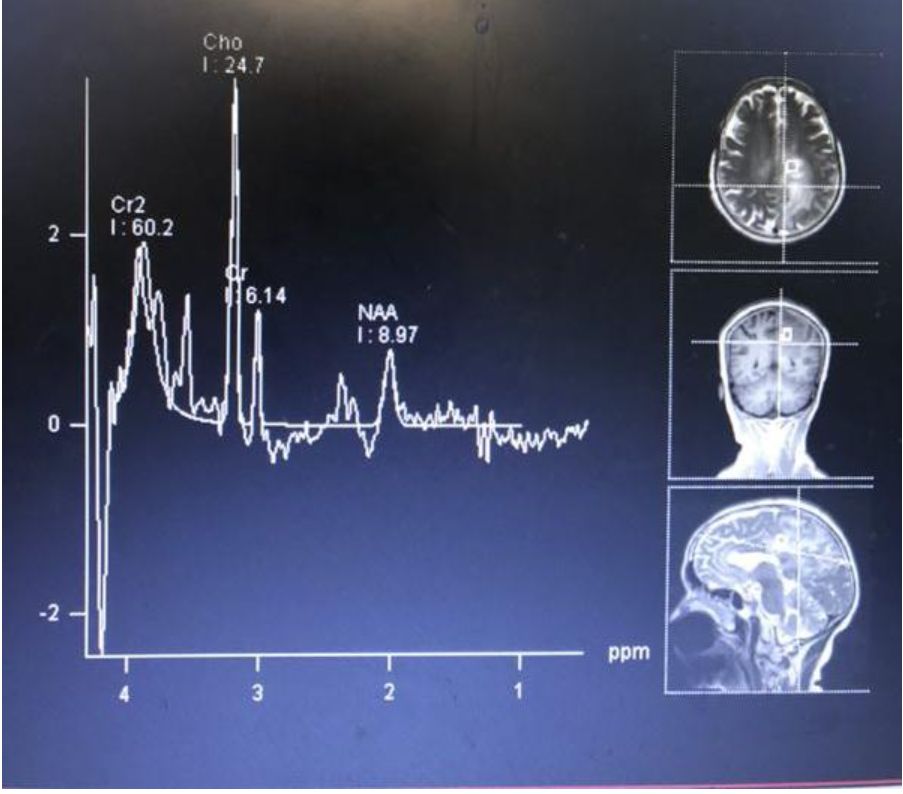 Whipple病、纹状体手、神经结节病、脱髓鞘假瘤丨3分钟读片·第16期