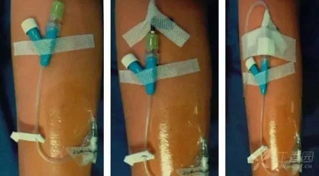 留置针u型敷贴正确撕法,留置针正确固定图片ppt