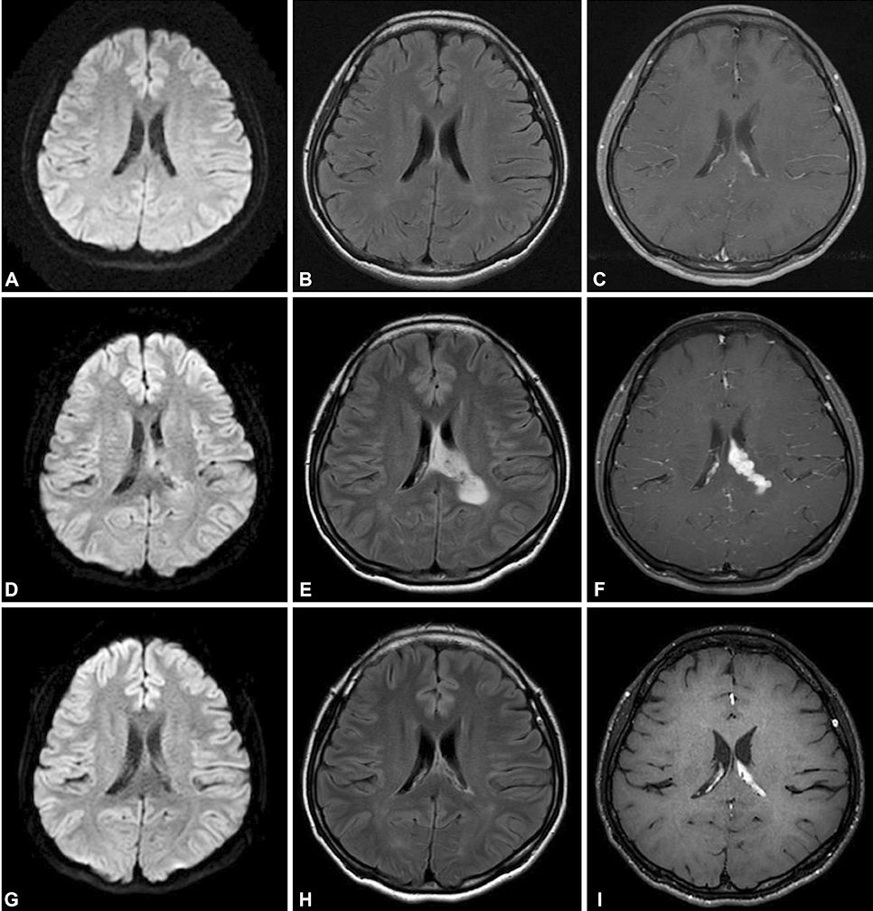 矛盾反应、Carney综合征、脑梗死、笑气中毒丨3分钟读片·第19期