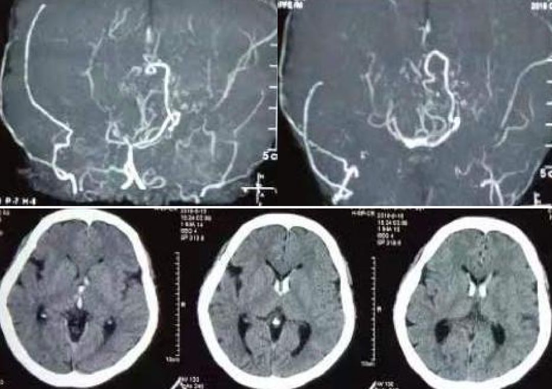 矛盾反应、Carney综合征、脑梗死、笑气中毒丨3分钟读片·第19期