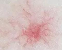 去*血丝红**有效的方法?三步法告别大红脸