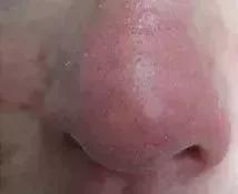 去*血丝红**有效的方法?三步法告别大红脸