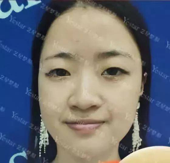 十大骗局肉毒素药,微整形注射假药案例