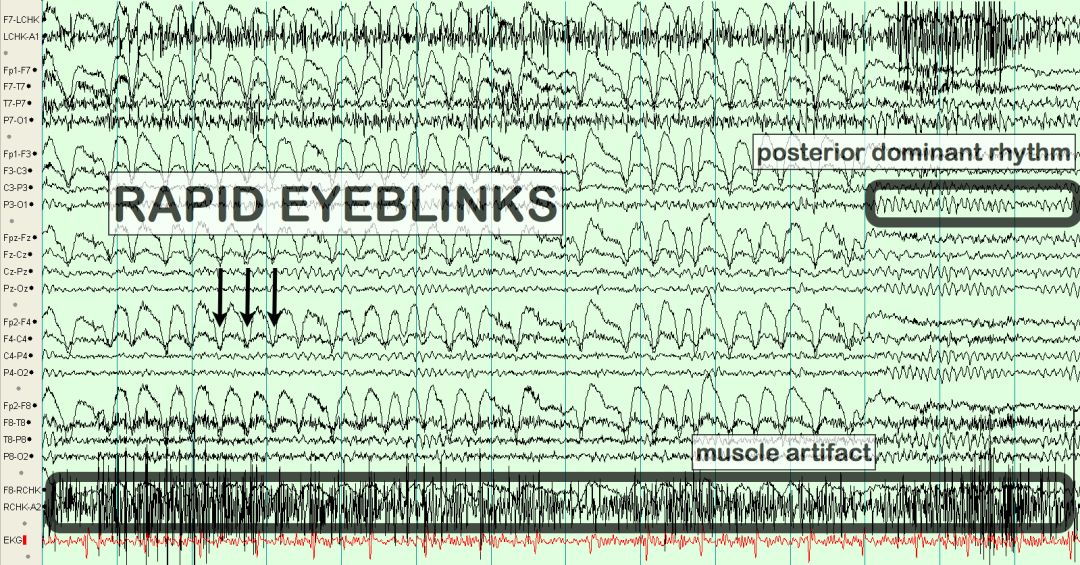 脑电图伪差图,脑电图伪差图谱