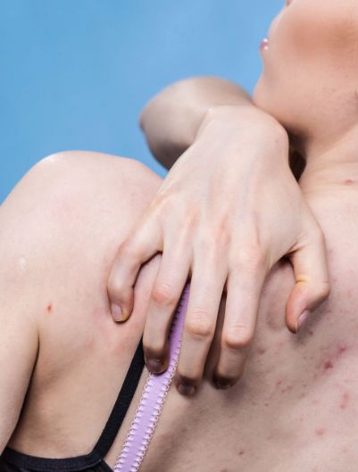 脖子后背长痘怎样去除,脖子和背部长痘是什么原因