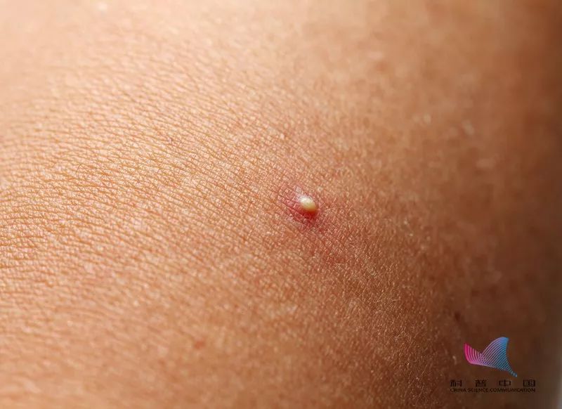 后背的疙瘩怎么去除,后背有疙瘩怎么去除