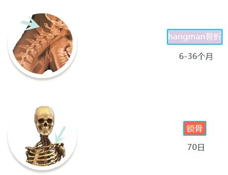 「骨科康复」骨折愈合分期和愈合时间