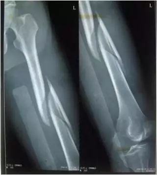 *花爆烟竹**炸伤如何急救？