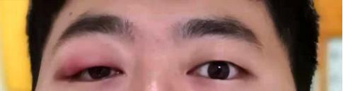 肖战麦粒肿上热搜！什么，眼皮红肿热痛就是麦粒肿？麦粒肿：这个锅我不背