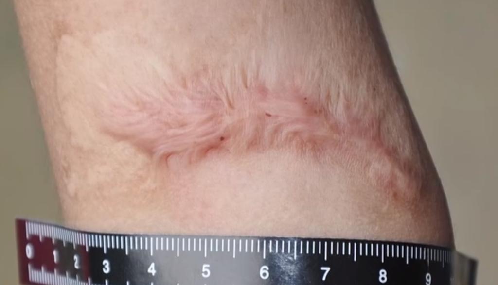 针扎、开水烫……她把9岁女儿打到全身骨折被捕后说“我觉得打她是对的”