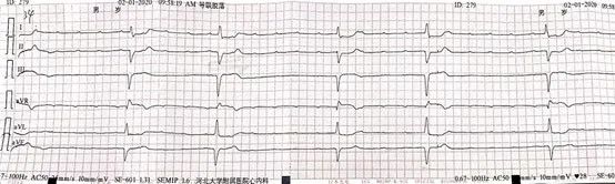 一度房室传导阻滞是怎么得的,三度房室传导阻滞最简单看法