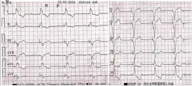 一度房室传导阻滞是怎么得的,三度房室传导阻滞最简单看法