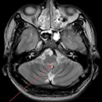 延髓外侧综合征口诀,延髓背外侧综合征典型病例