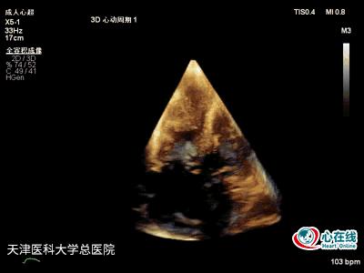 超声心动图发现赘生物,超声心动图检查结果疑似赘生物