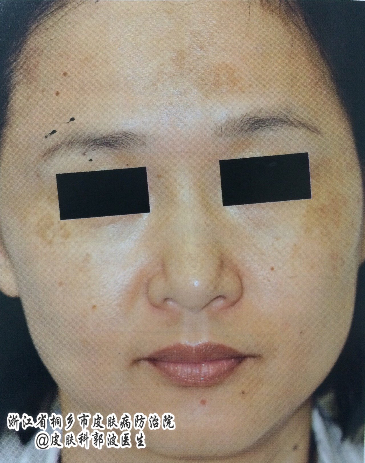 长褐斑是什么原因造成的,褐青斑是什么原因引起