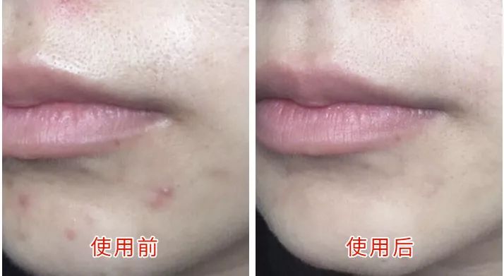 挤痘痘出来的白色长条状是什么,痘痘黑头挤出白颗粒