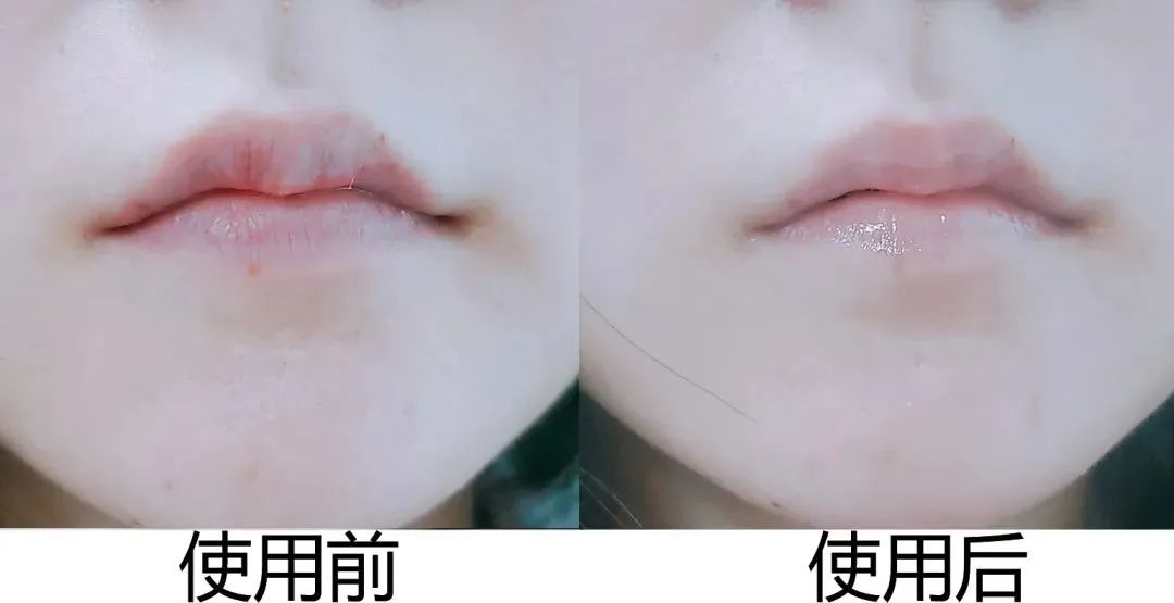 嘴唇干裂起皮等皮掉了涂唇膏,嘴唇干脱皮用什么唇部护理比较好?