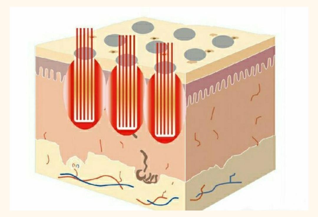 黑头痘印怎么去除,黑头痘印怎么消除学生党