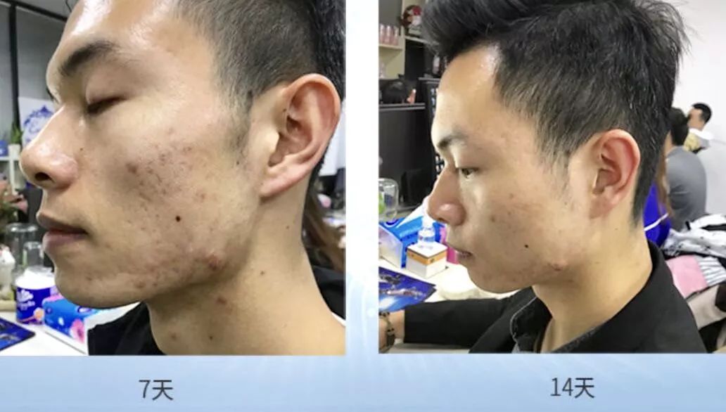 新西兰人气蜂蜜面霜，质地像果冻一样清透，超级补水！还能祛痘、缩毛孔