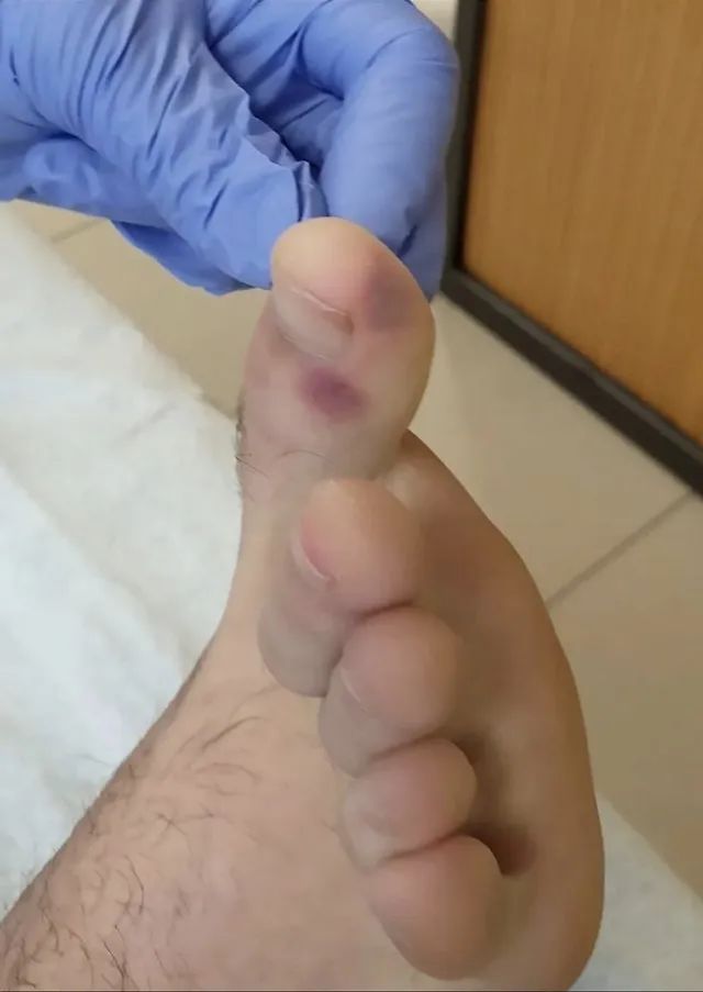 新冠病毒手上会起痘吗,新冠病毒长痘吗