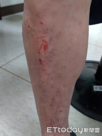 红疹破皮搔痒难耐　恼人湿疹痒3年中医调理半年止痒