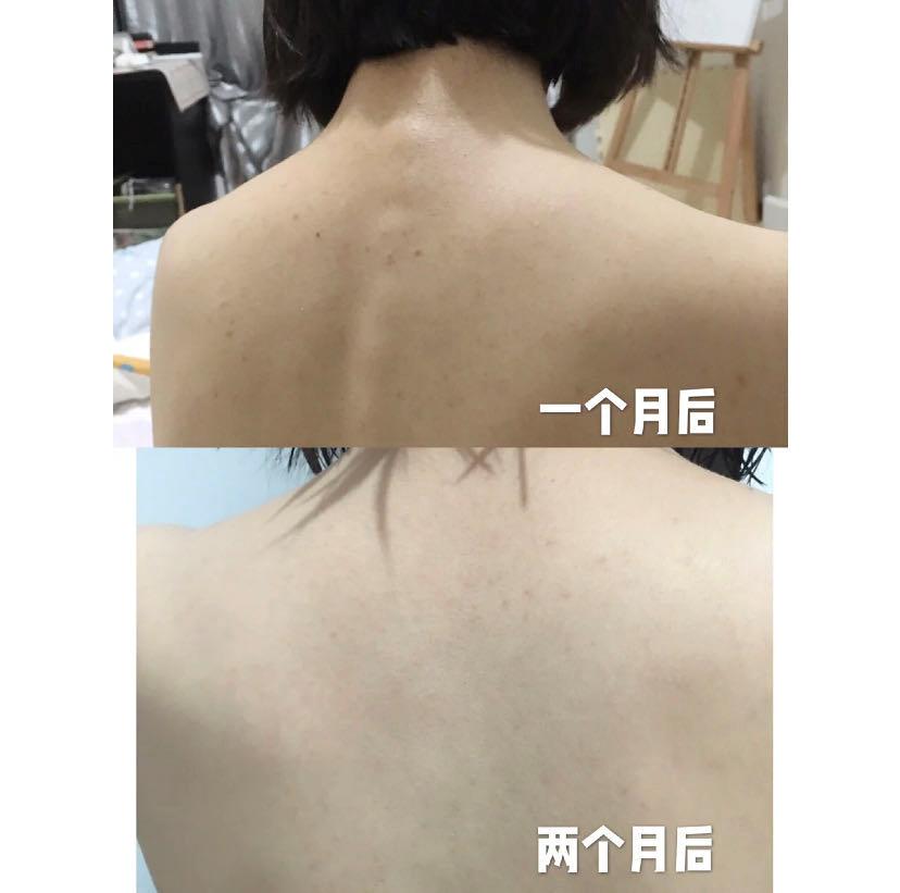 日本绿瓶的祛痘喷雾叫什么,清爽型祛痘喷雾