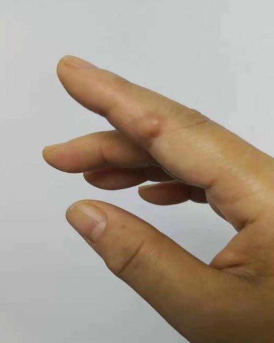 【筋伤园地】想要治疗疤痕，不妨这样试试