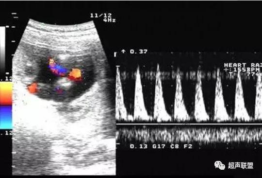 胎儿宫内窘迫通过什么检查出来的,胎儿宫内缺氧的超声视频