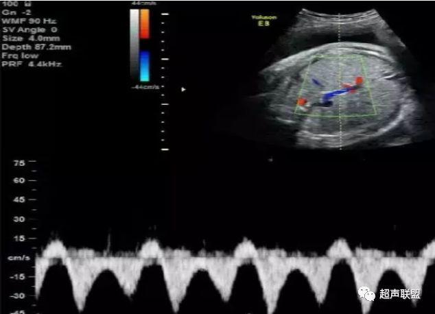 胎儿宫内窘迫通过什么检查出来的,胎儿宫内缺氧的超声视频