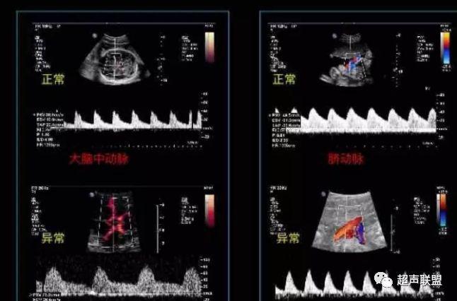 胎儿宫内窘迫通过什么检查出来的,胎儿宫内缺氧的超声视频