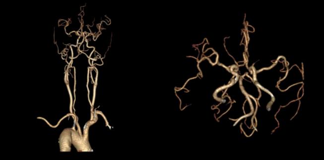 左侧大脑后动脉开窗畸形图片,脑部基底动脉开窗畸形如何治疗