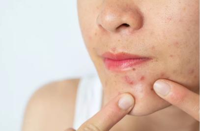 戴口罩会导致痘痘严重吗,长期戴口罩长痘怎么办