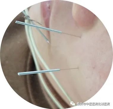 不用住院，医保报销！临沂这家医院的“中医日间病房”太赞了