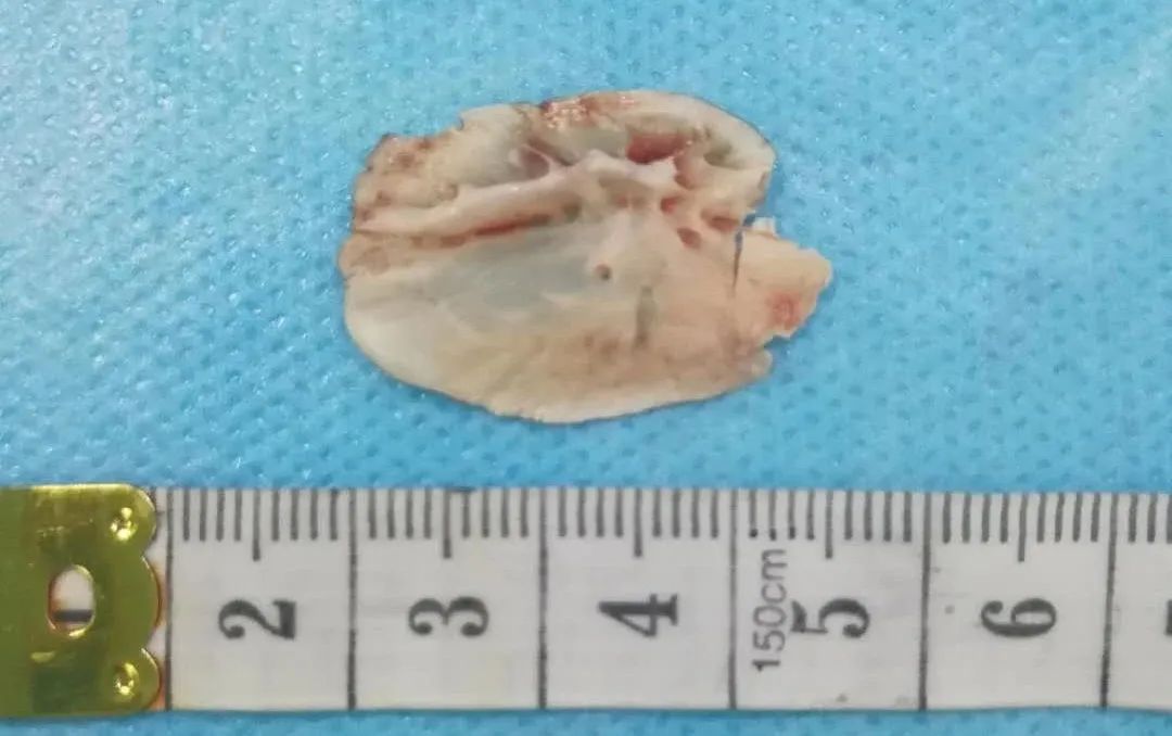 凶险！一口气喝完鱼汤后胸口刺痛！没想到竟需要8个科室10多位专家联手……