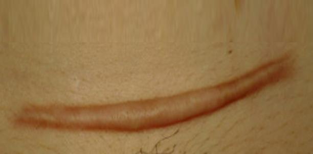 瘢痕体质留疤了怎么办,只有开刀才长疤是瘢痕体质吗