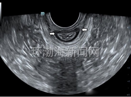 唐山工人医院超诊科一项检查解决女性患者多日“尴尬”