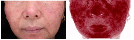 最近的脸又痒、又红、还发烫，华西专家说，你多半是遭了敏感性皮肤了！