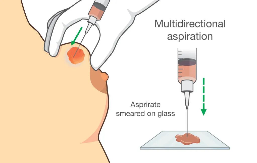 乳房疼痛有硬块与妇科病有关吗,乳房有硬块疼痛怎么区分是不是癌