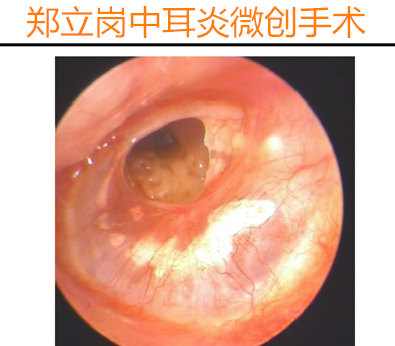 中耳炎鼓膜穿孔微创手术多久恢复,鼓膜穿孔可以不治疗吗