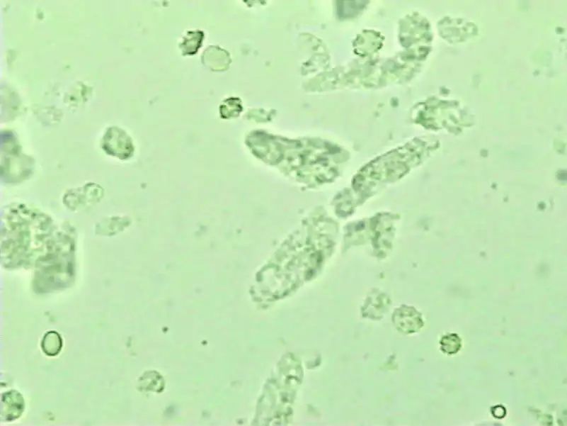 尿液有形成分检查,尿液中检测到的有形成分有哪些