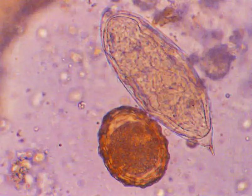 尿液中有肉眼可见杂质正常吗,尿液有形成分检查细菌偏高
