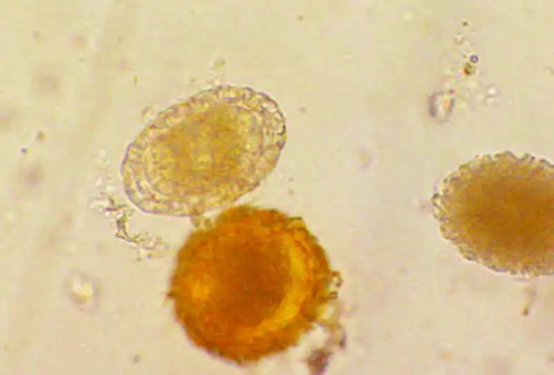 尿液中的有形成分红细胞,尿液中常见的有形成分