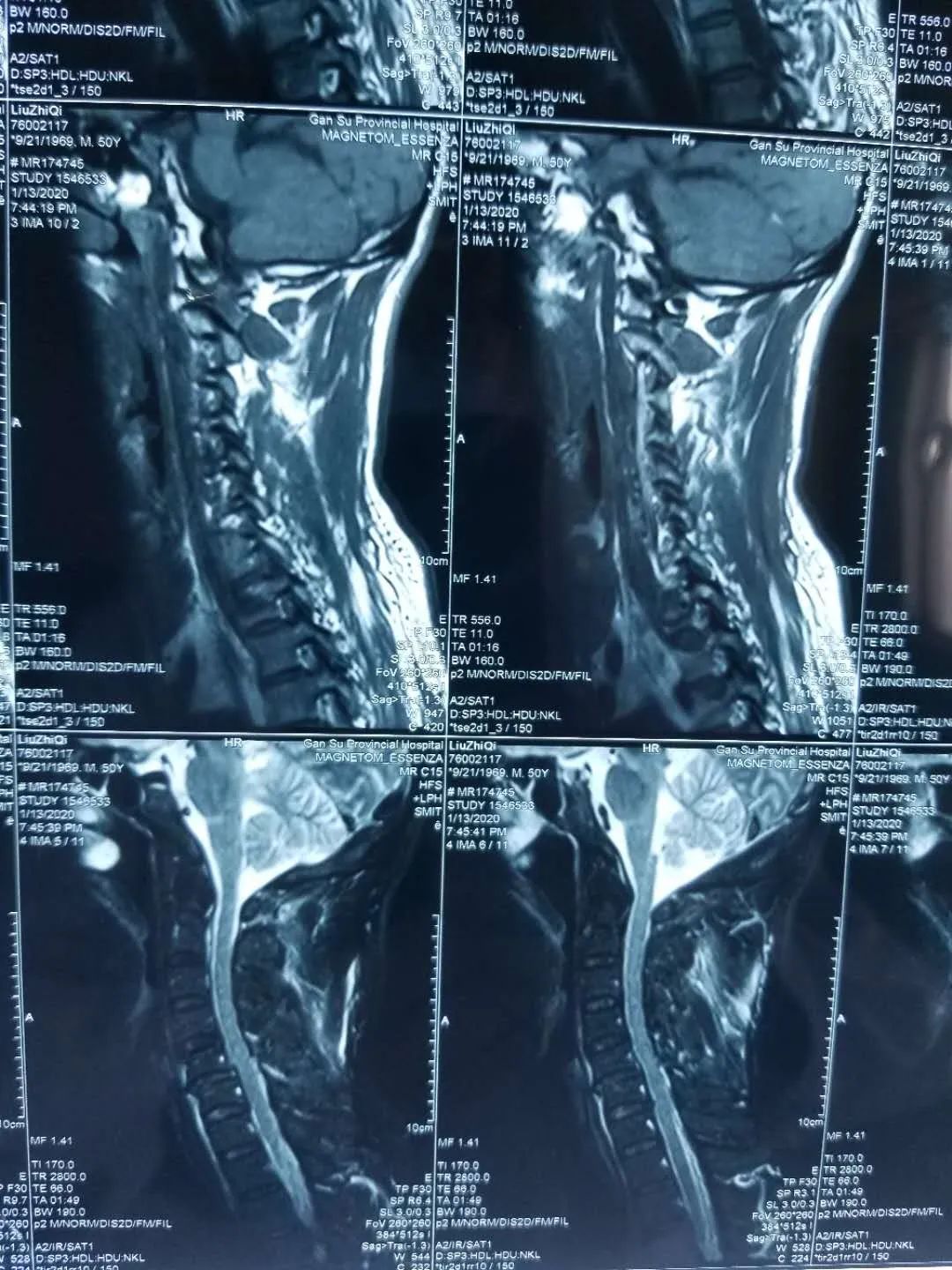 颈椎脱位莫大意,专业医治防瘫痪——省中医院李红专主任团队成功治疗一例复杂陈旧性颈椎骨折脱位患者