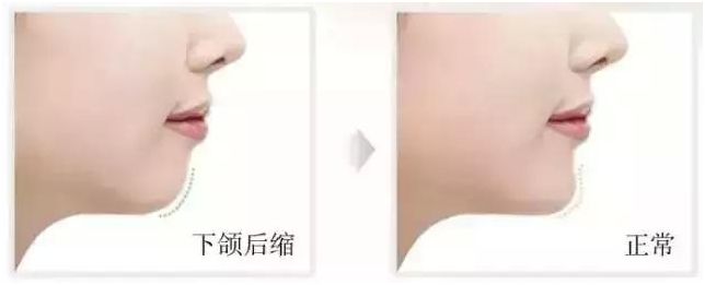 矫正牙齿的最佳年龄和价格表,孩子矫正牙齿多大年龄最合适