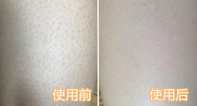 啤酒消痘痘,喝啤酒会消除痘痘吗