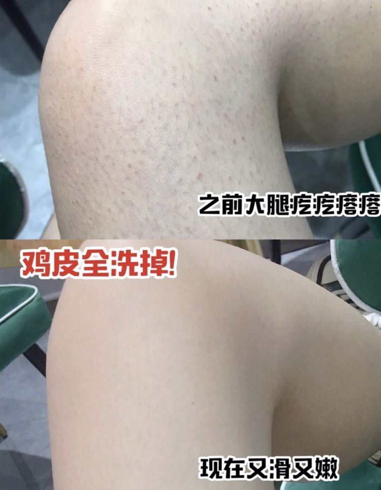 别放弃，烦人的“鸡皮疙瘩”，真的还可以再救一下