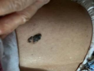 容易癌变的痣去哪里切除,从小就有的痣要切除吗