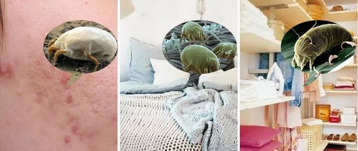 挤痘痘出来的白色长条状是什么,痘痘黑头挤出白颗粒